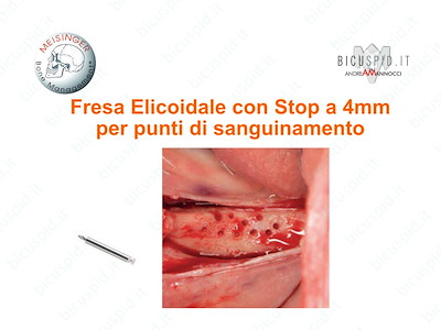 Fresa Elicoidale con Stop per i punti di sanguinamento