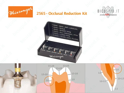 Kit per la riduzione Occlusale Meisinger