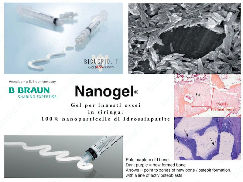 NANOGEL - Gel per innesti ossei in siringa - Nanoparticelle di idrosiapatite- Codice
