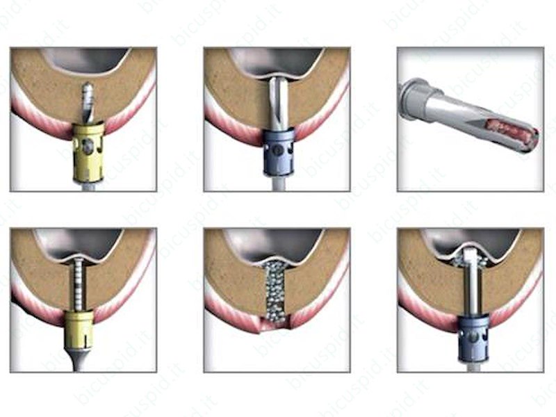 Mini rialzo del seno kit completo -Crestal-Lift Control, Meisinger
