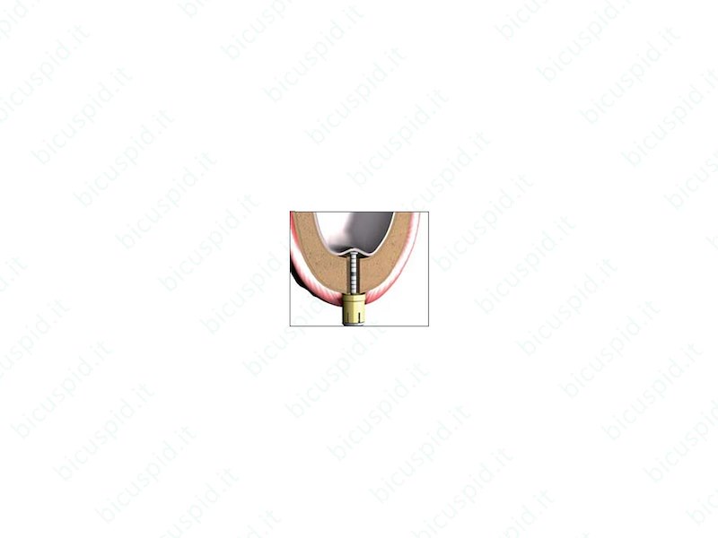 Sonda di profondità per Crestal Lift Control Meisinger CL021