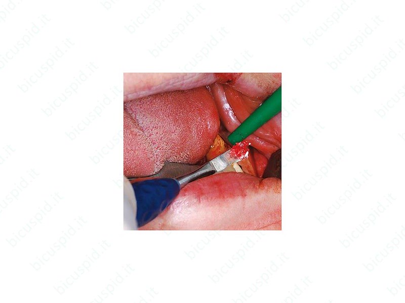 DX254R Curette ossea Aesculap 