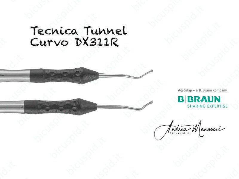DX311R  Strumento angolato per la Tecnica del Tunnel o Tunnel technique - Ergoperio