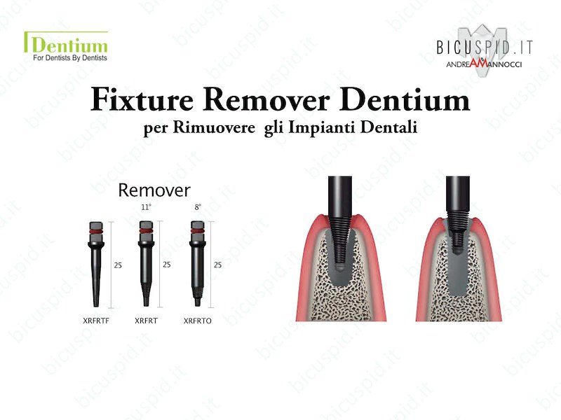 Fixture Remover Dentium - Dispositivo di Rimozione degli impianti - i Componenti