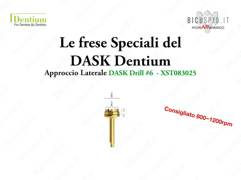 Le frese Speciali del DASK della Dentium - Approccio Laterale