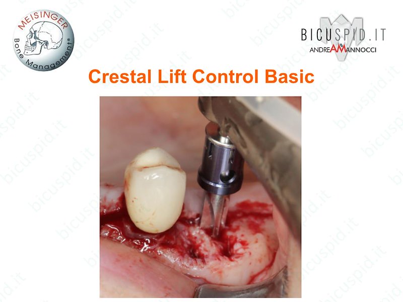 CCLBA   Crestal-Lift Control Mini Kit Rialzo del Seno kit Basic Meisinger
