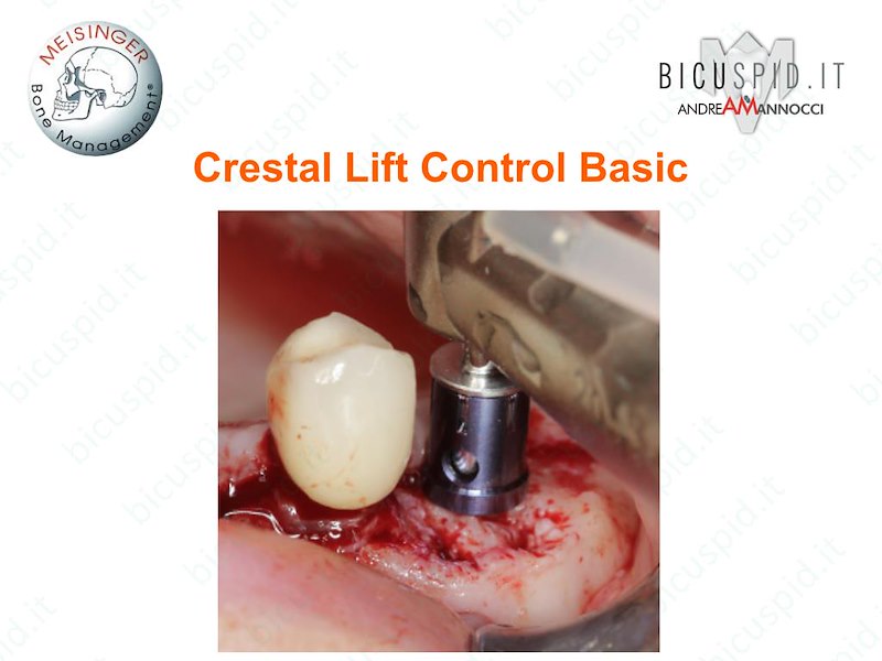 CCLBA   Crestal-Lift Control Mini Kit Rialzo del Seno kit Basic Meisinger